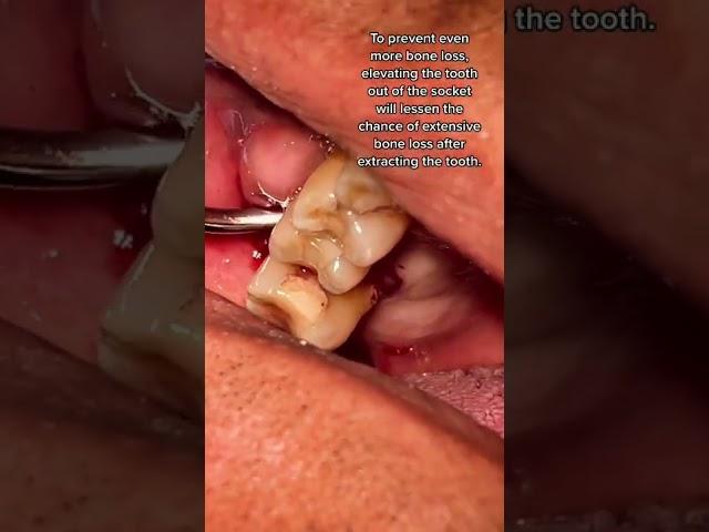 Broken Molar (Tooth #3) Extraction Using Tooth Elevator | In Office to Hands On Dental Training
