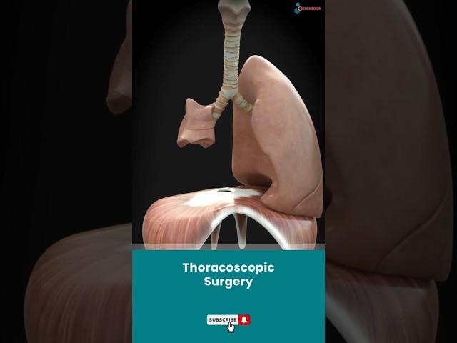 Video-Assisted Thoracoscopic Surgery (VATS)↪3D Medical Animation #Shorts #ThoracoscopicSurgery #VATS