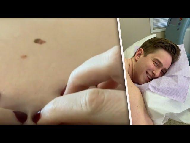 Woman Spots Cancerous Mole on TikTok’s Alex Griswold’s Back