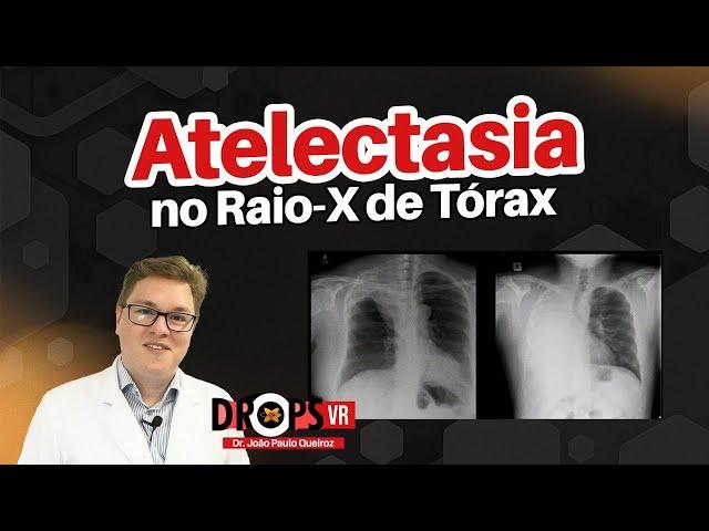 ATELECTASIA - APRENDA A RECONHECER NO RAIO-X DE TÓRAX I VOCÊ RADIOLOGISTA