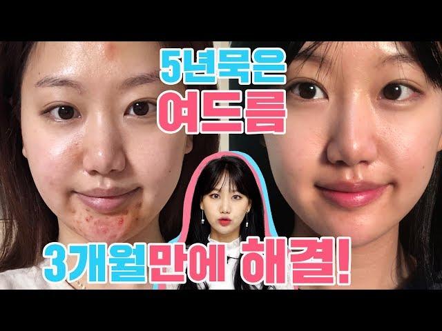 [3Mins Bora] How to get rid of cystic&inflammatory acne, how I manage acne-prone skin