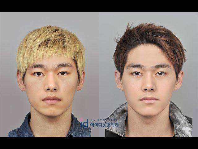 Guys Transform Into a Handsome Man, Plastic Surgery Korea Before and After