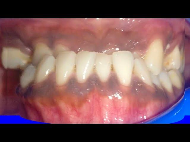 Orthodontics before and after! Invisalign Treatment: Case by Dr Vandana Katyal, Orthodontist