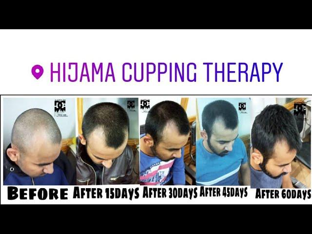 Hair Receeding Growth Treatment By Hijama Cupping Therapy