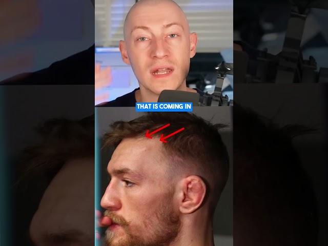 Did Conor McGregor Have A Hair Transplant?