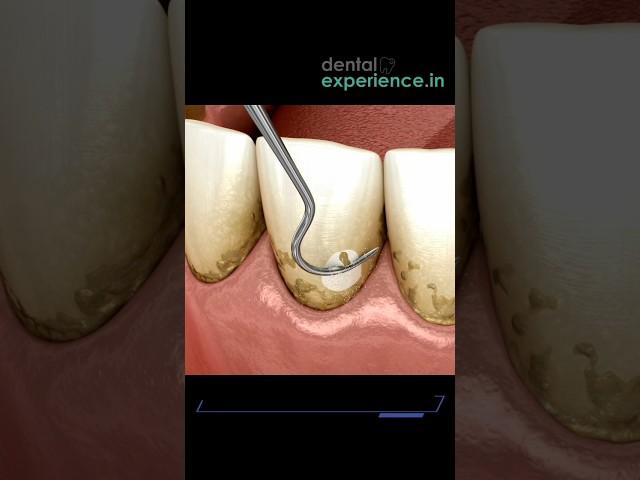 Tooth Cleaning | Teeth Scaling I stain or Tartar Removal cost in Kochi, Kerala | Dentalexperience.in