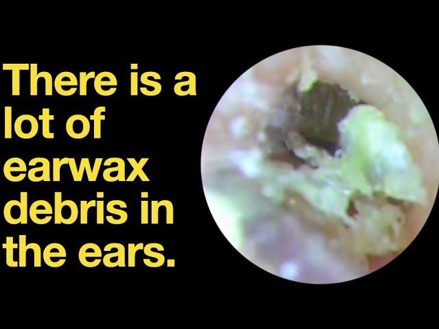 There is a lot of earwax debris in the ears.|ear wax removal | ear cleaning | ASMR | relaxation