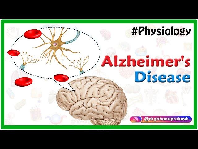 Alzheimer's disease : Etiology, Pathophysiology, Signs and symptoms, Diagnosis and Treatment