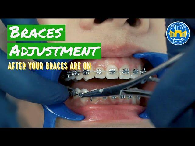 How Do Braces Straighten Teeth?