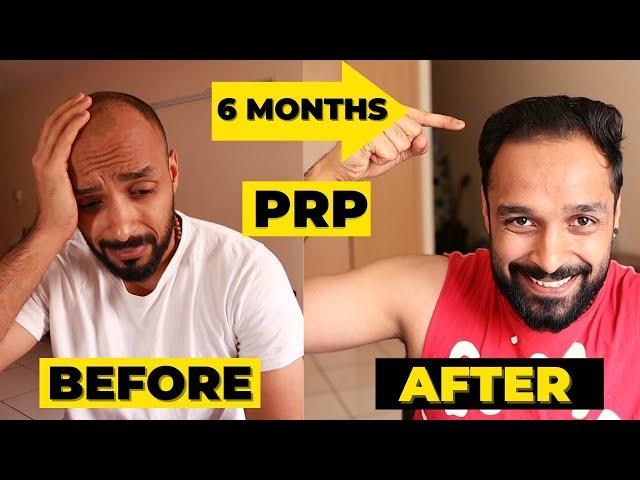  PRP 6 MONTH RESULTS - 3 PRP sessions | HAIR TRANSPLANT vs PRP which one should you really go for?