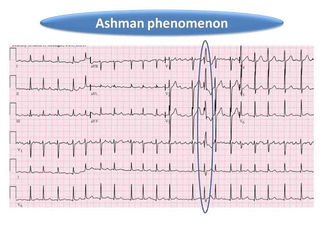 ECG course: Ashman Phenomenon, Dr. Sherif Altoukhy