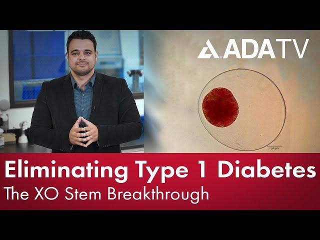 Eliminating Type 1 Diabetes: The XOStem Breakthrough