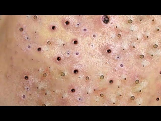 Relax Skincare Everyday with Acne Blackheads Treatment Spa #91016