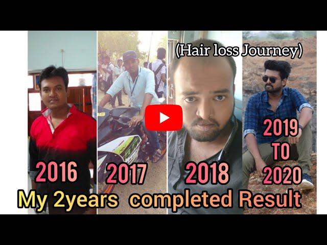 2years Completed Hair Transplant Result | My Hair Transplant Journey| Best Tamil Hair Transplant