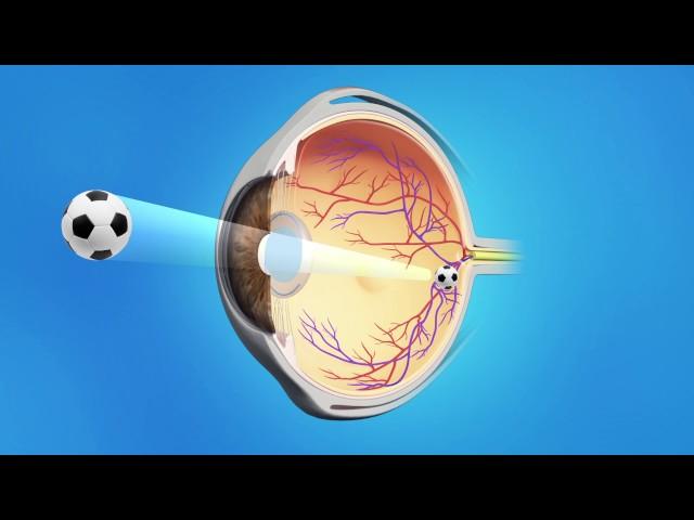 Cataract Surgery with a Monofocal Lens