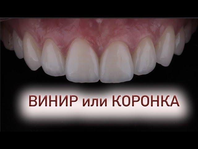 Винир или коронка? Что выбрать и почему?