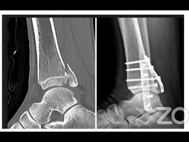 Modernization of Ankle Fracture Management