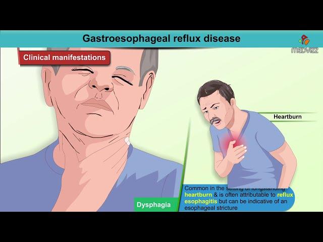 Gastroesophageal reflux disease Animation / GERD : Etiology , Diagnosis , Pathology , Treatment