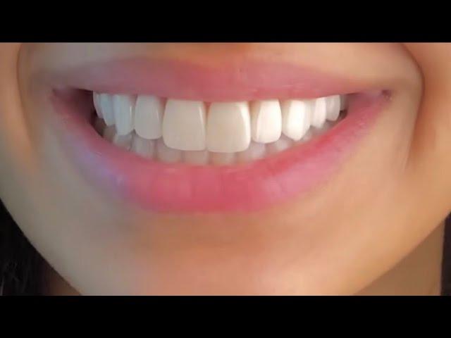 ღ your teeth are literally perfect! ~ veneers procedure 