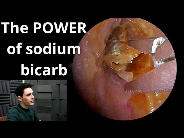 Sodium Bicarbonate Drops VS Earwax & Dead Skin