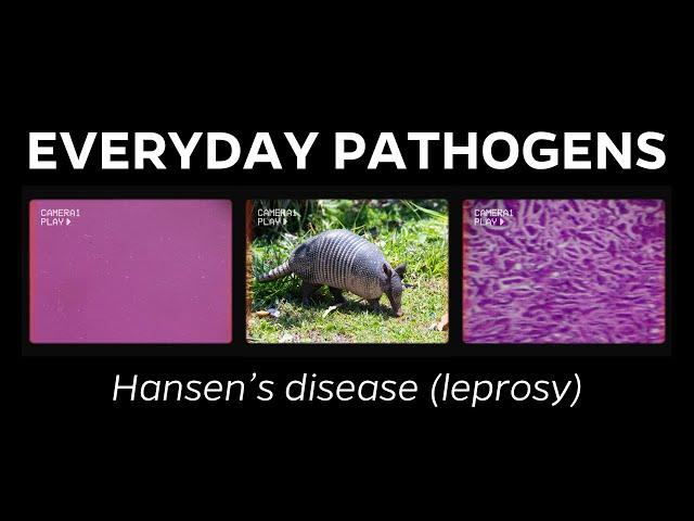 What is leprosy? A brief overview of Hansen's disease and impact in Florida.