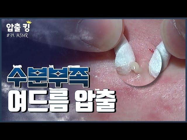 [압출킹] 39. 겨울철 수분부족 여드름 압출 ASMR 시원함 주의!