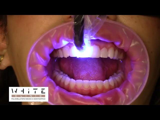 Faccette estetiche dentali - White Clinic