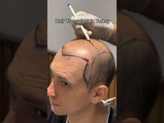 Hair Transplant in Turkey | Hair Transplant Process #hairtransplant