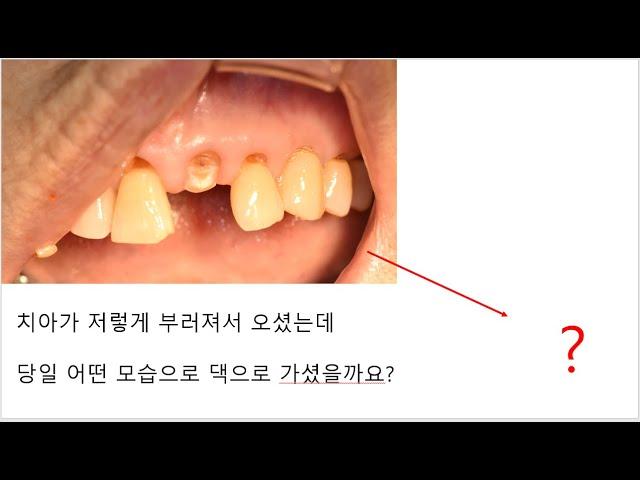 2-72-3-5  윗앞니가 부러졌을 때 덴티움 브라이트를 이용한 발치즉시식립 즉시부하(immediate loading 부산 임플란트 광안리 뉴욕치과)
