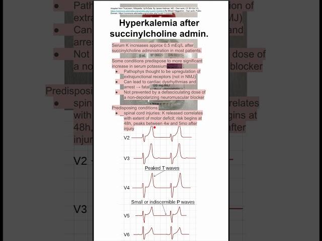 Hyperkalemia after succinylcholine admin.