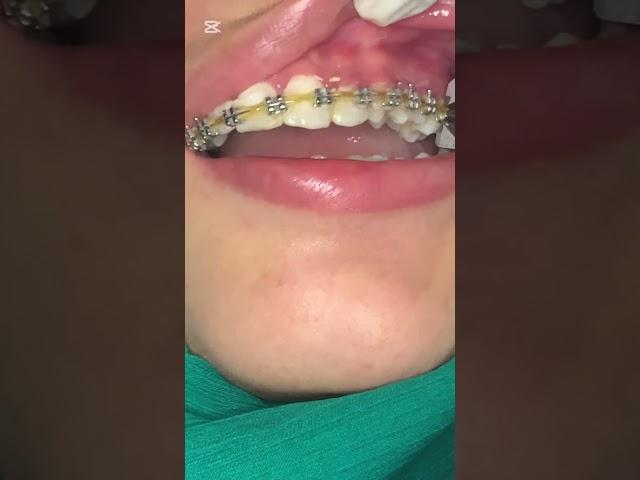 Removing brackets #umairtoothfairy #dentist #satisfying #umairazeem #shorts @Umairazeem8553