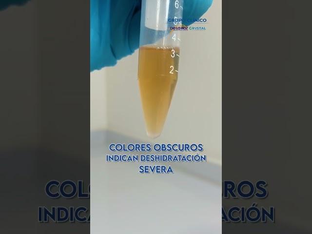  Conoce lo que dice el color de tu orina.