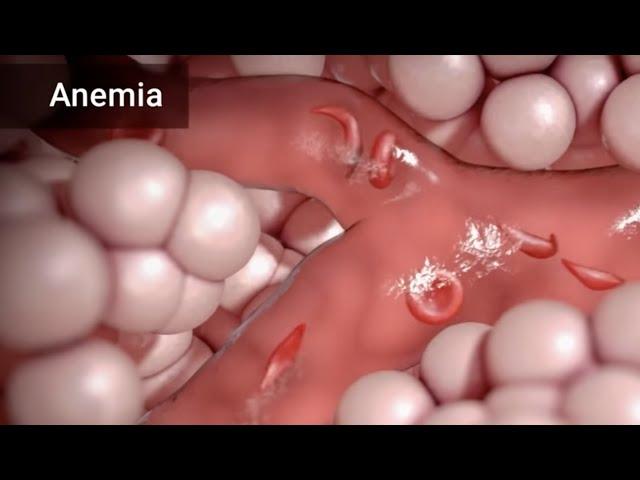 Treatment for Sickle Cell Anemia