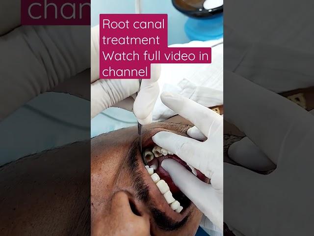 #rootcanaltreatment #doctors #rootcanaltreatment #doctors #toothcavity #zirconiacrown #rct #filling