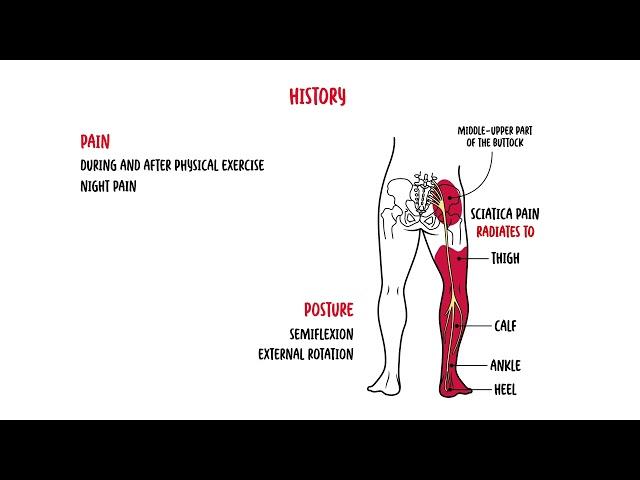 Piriformis Syndrome (buttock pain, siatica)