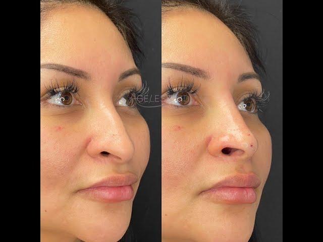 Non-Surgical Nose Job + Mint PDO Nose Tip Lift - Ageless MD