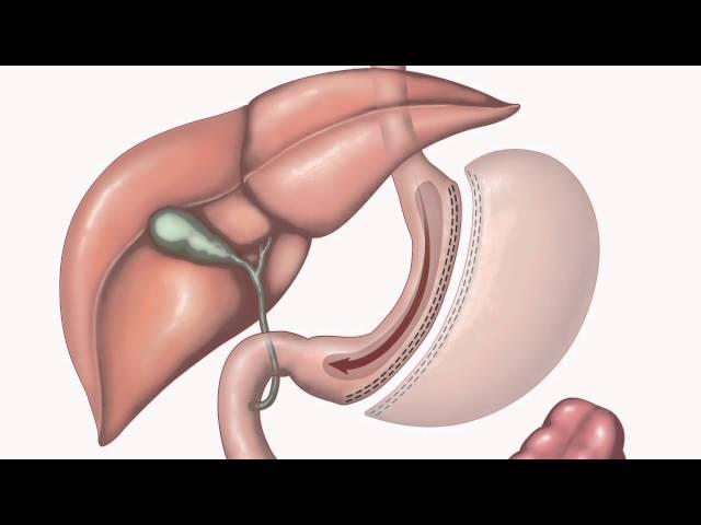 Bariatric Surgery | Types of surgery | 2/3