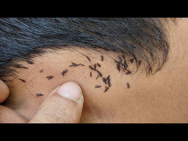 How to get rid of head lice fastly - Comb those big head lice at home