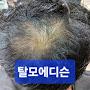@탈모에디슨