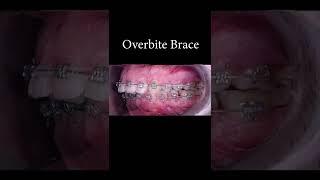 Overbite brace before after #shorts #braces #orthodontist