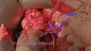 pancreatic head resection - 1   برداشتن سر لوزالمعده