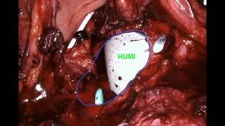 3  Robotic Assisted Repair of Vesico Utero Cervico Vaginal Fistula VCVF