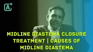 MIDLINE DIASTEMA CLOSURE TREATMENT | CAUSES OF MIDLINE DIASTEMA | By Dr Seby Varghese