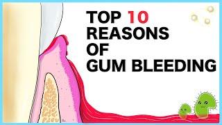 Gum Bleeding: Top 10 causes