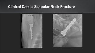 OrthoLine™ Fracture Management System: Clinical Case Series