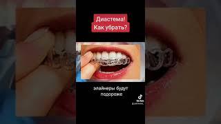 Диастема! Как убрать?