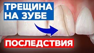 Проверь свои зубы — вдруг есть ТРЕЩИНА?! | Чем опасны трещины на зубах?