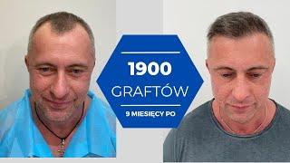 1900 graftów 9 miesięcy po. Przeszczep włosów Wrocław FUE. Hair transplant results. Efekt przed i po