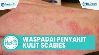 Penyakit Kulit Scabies Perlu Diwaspadai, Ternyata Bisa Menyerang Seluruh Tubuh