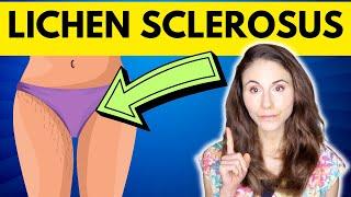 Lichen Sclerosus: WHY YOU HAVE IT & HOW TO TREAT IT